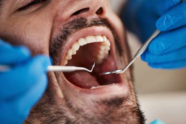 Best Emergency Dentist for Lost Fillings or Crowns in Finley, WA